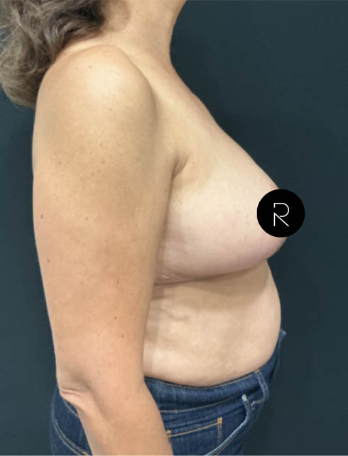 Breast Lift/Reduction