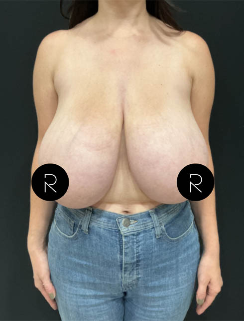 Breast Lift/Reduction