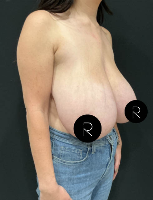 Breast Lift/Reduction