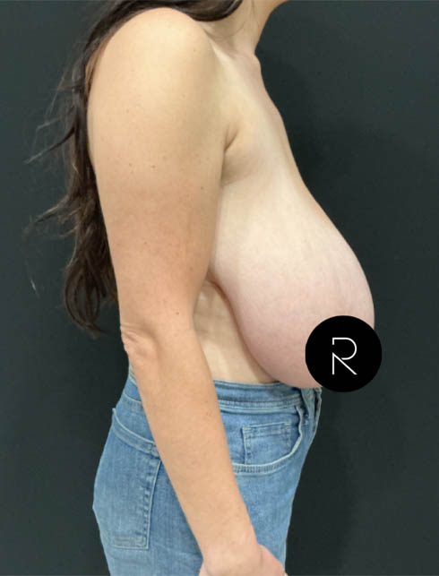 Breast Lift/Reduction