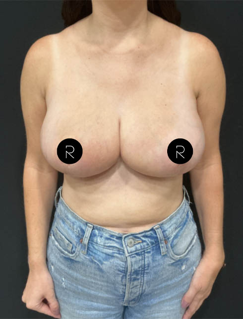 Breast Lift/Reduction