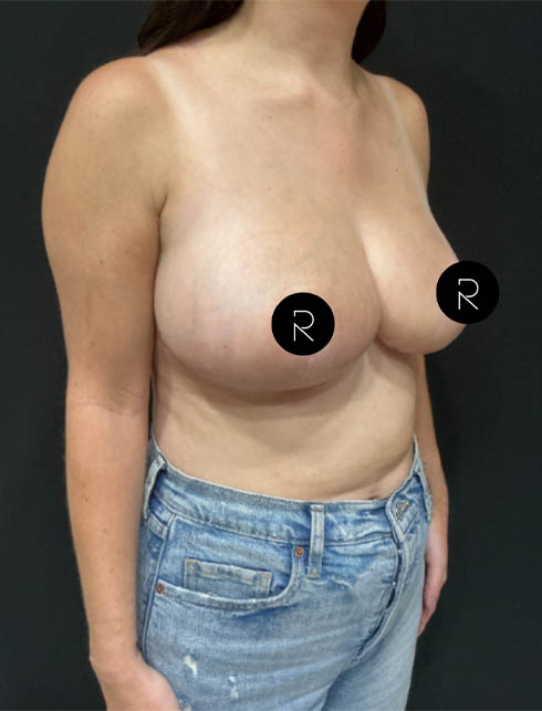 Breast Lift/Reduction