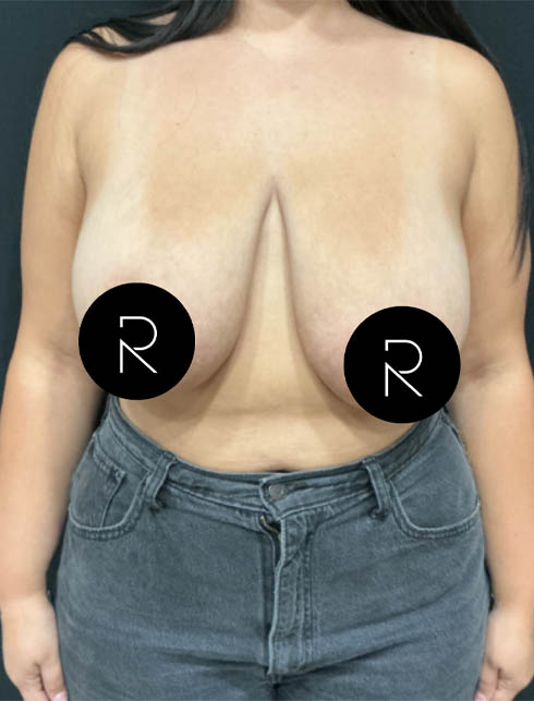 Breast Lift/Reduction