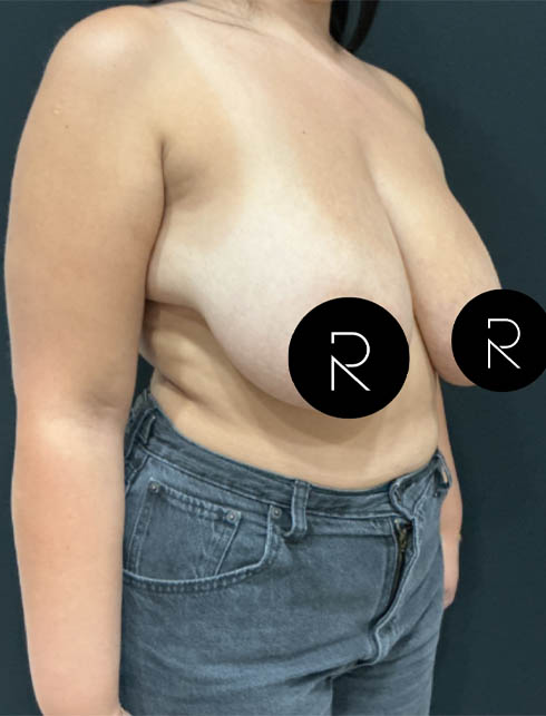 Breast Lift/Reduction