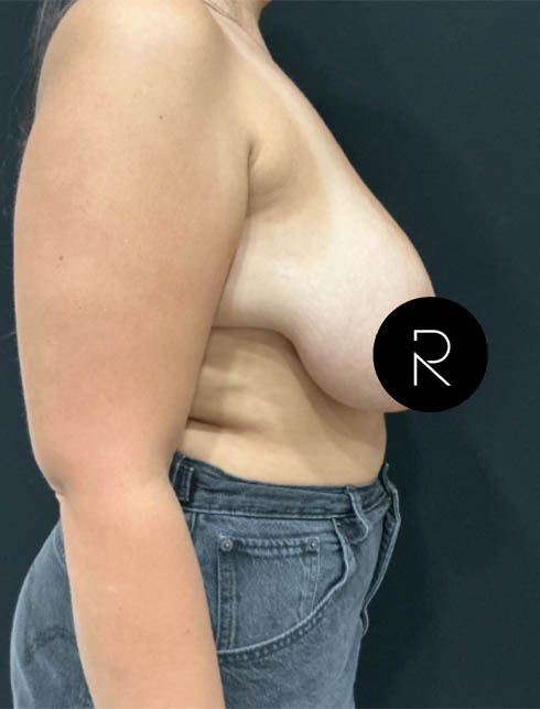 Breast Lift/Reduction