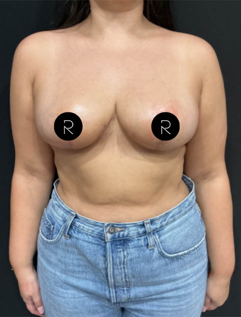 Breast Lift/Reduction
