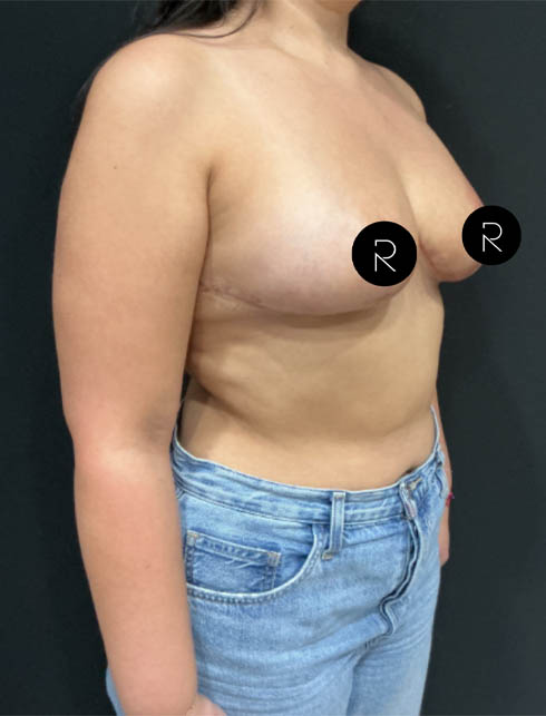 Breast Lift/Reduction
