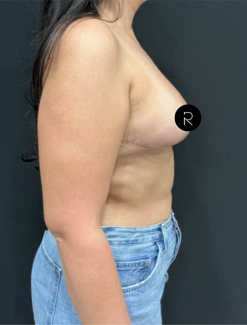 Breast Lift/Reduction