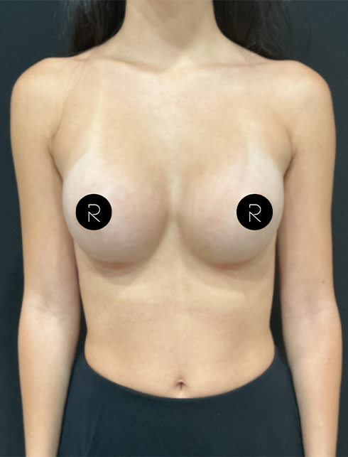 Breast Augmentation