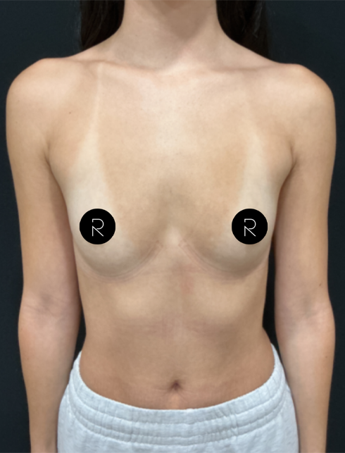 Breast Augmentation