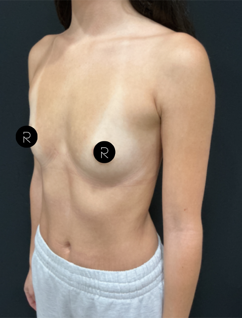 Breast Augmentation