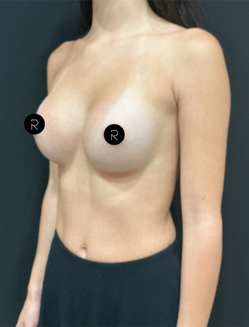 Breast Augmentation