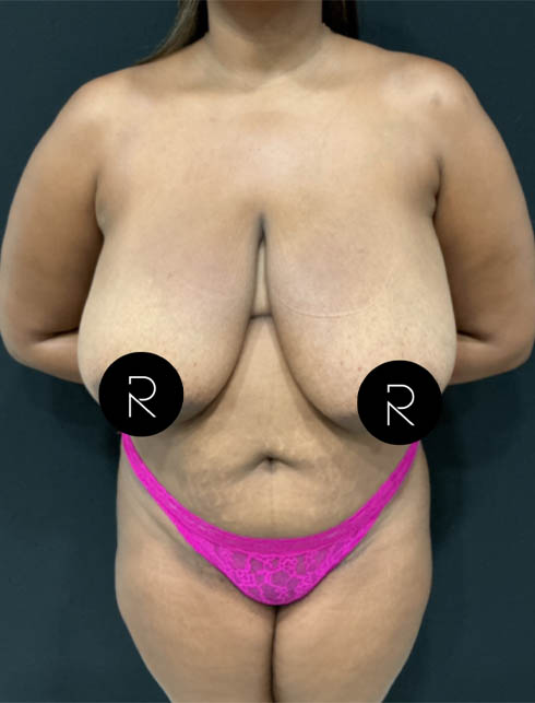 Breast Lift/Reduction