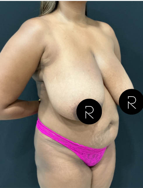 Breast Lift/Reduction