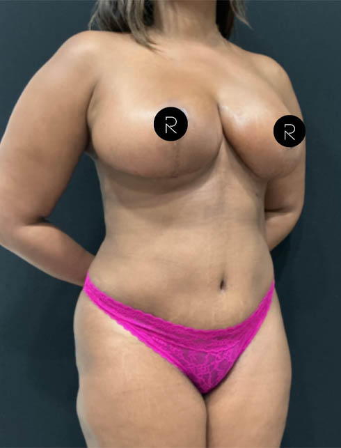 Breast Lift/Reduction
