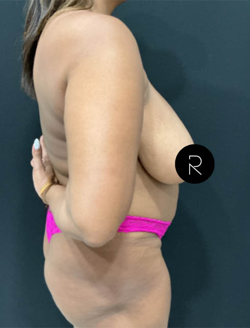 Breast Lift/Reduction