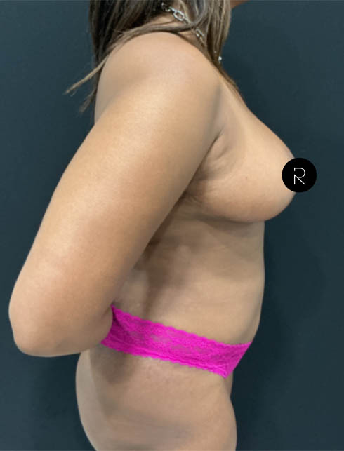 Breast Lift/Reduction